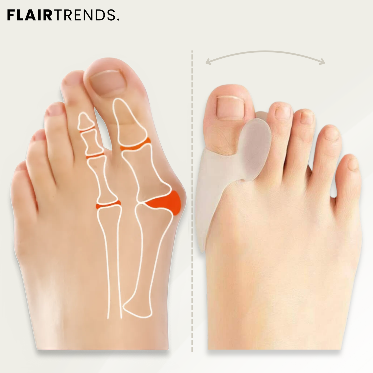 ToeGuard – Gentle Correction for Hallux Valgus!