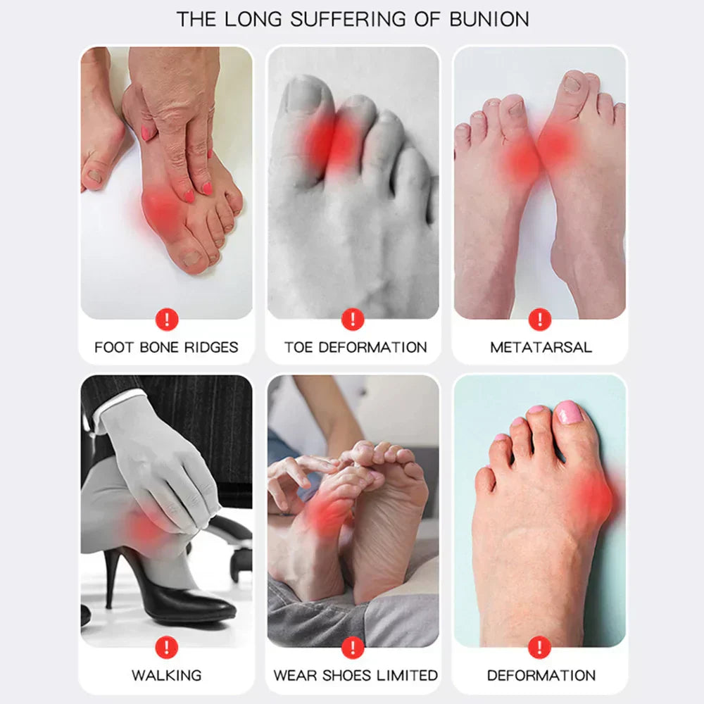 OrthoFlex – Pain-Free Steps with Hallux Valgus!