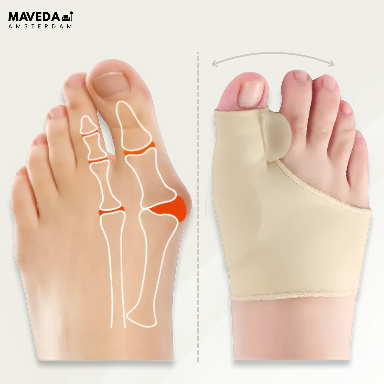 OrthoToe – Immediate Pain Relief from Hallux Valgus