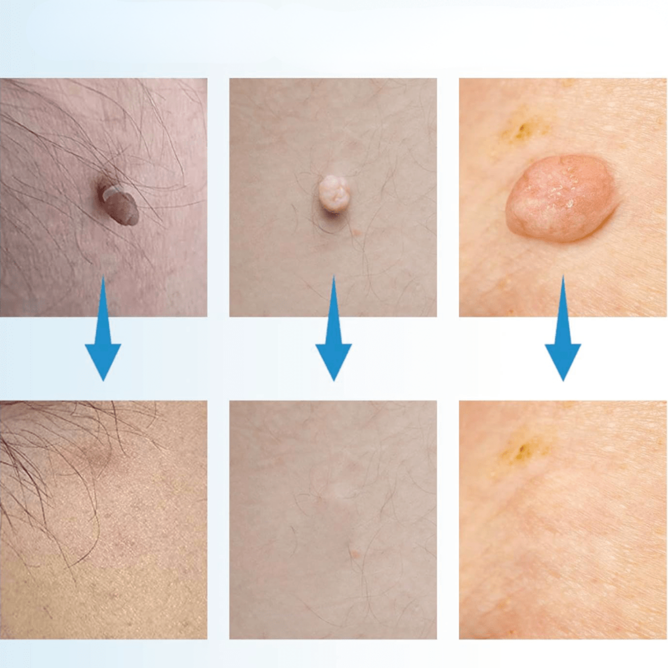 WartAway – Remove Warts Naturally, Without Chemicals!
