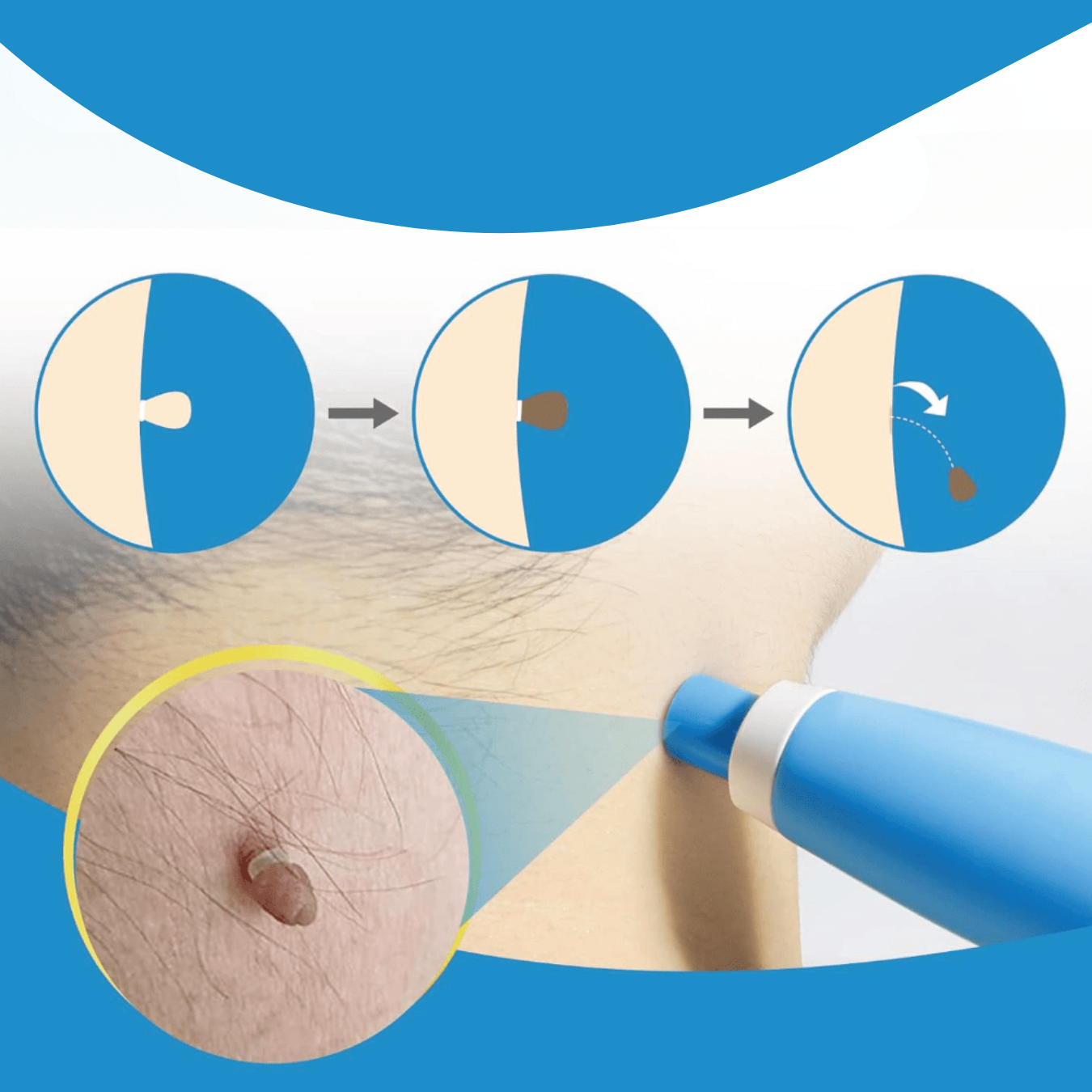 WartAway – Remove Warts Naturally, Without Chemicals!