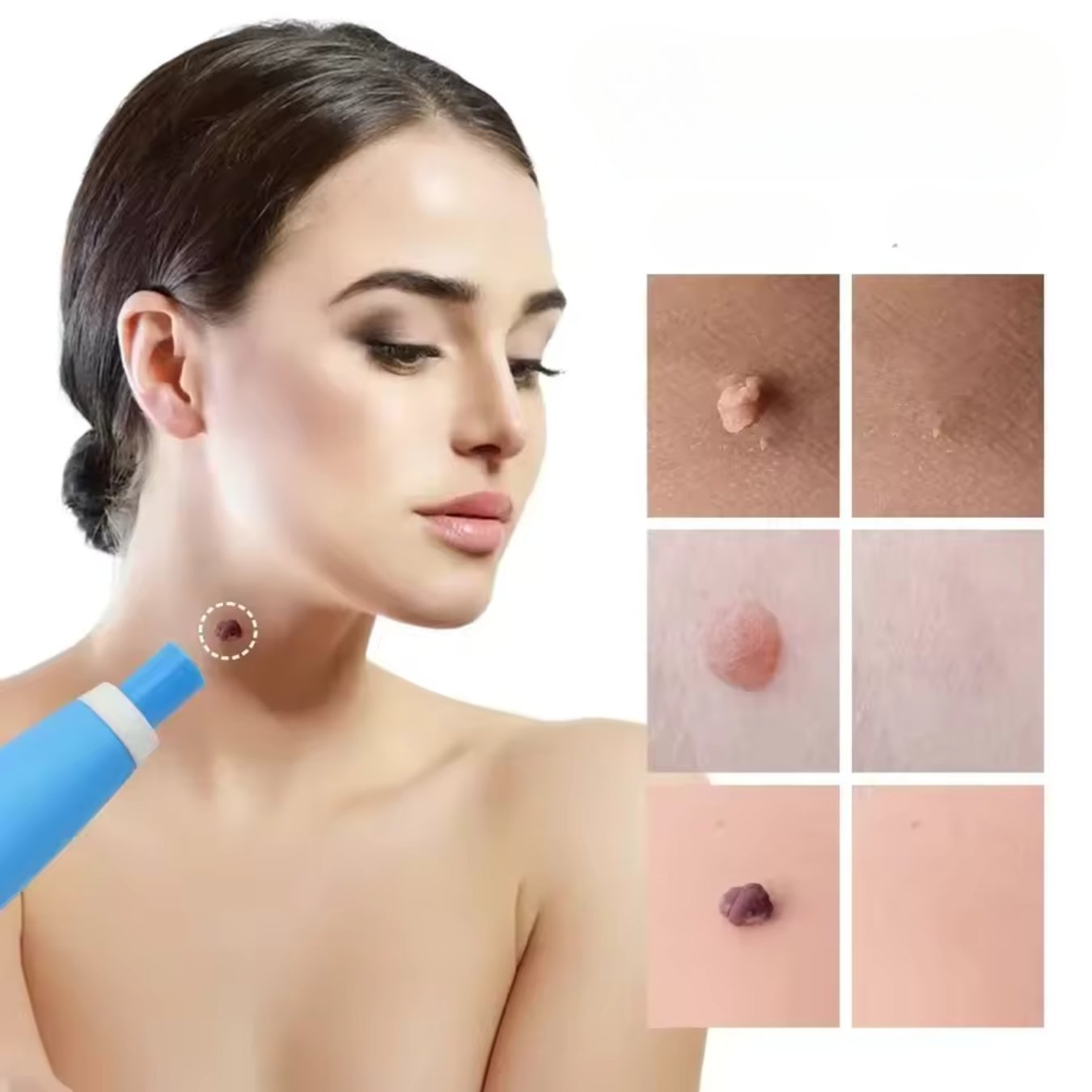 WartAway – Remove Warts Naturally, Without Chemicals!
