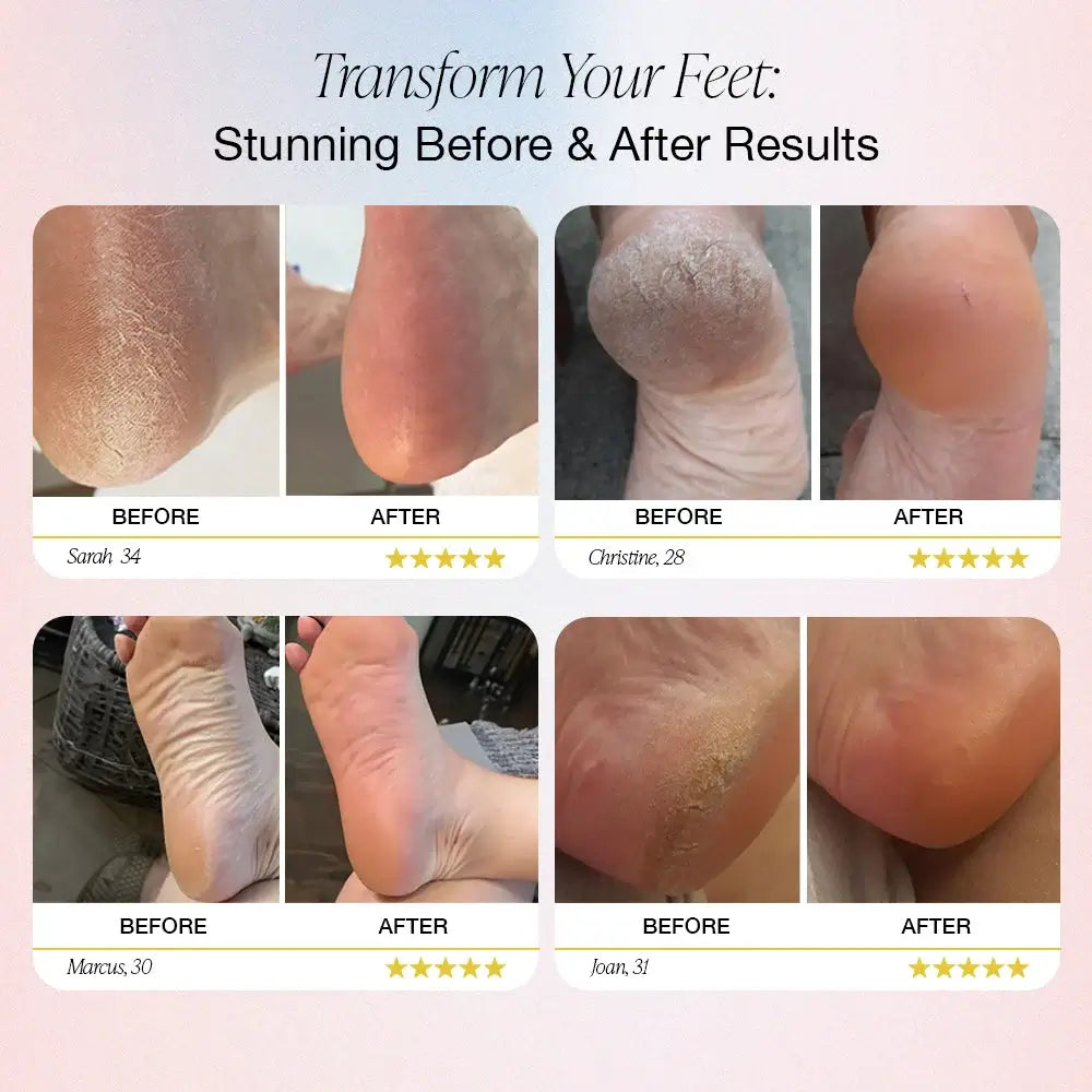 SoftFeet – Silky Smooth Feet in Minutes, Not Weeks