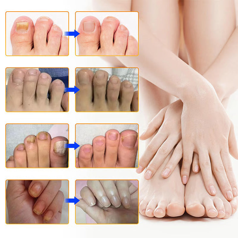 FungoStop – Restore Healthy Nails While You Sleep!