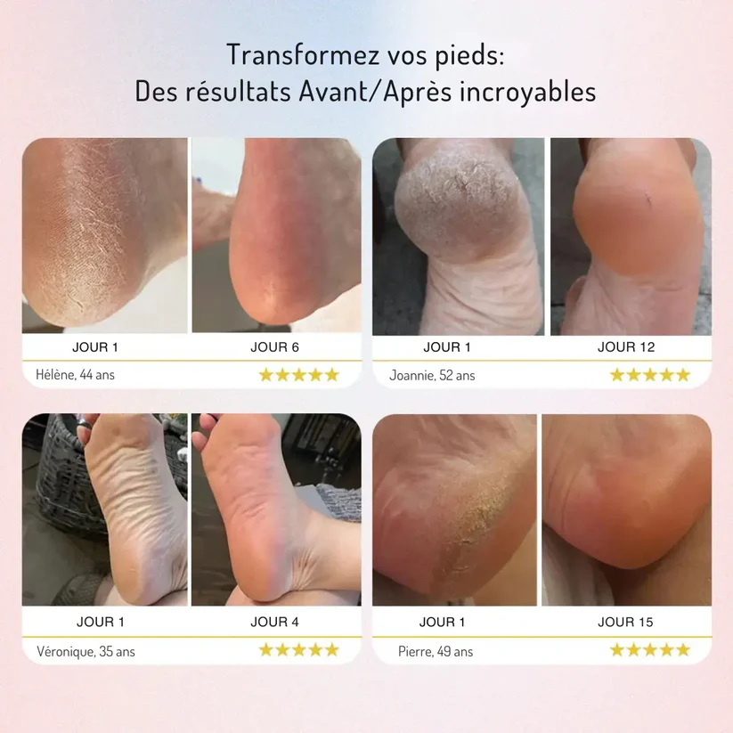 SoftFeet – Silky Smooth Feet in Minutes, Not Weeks