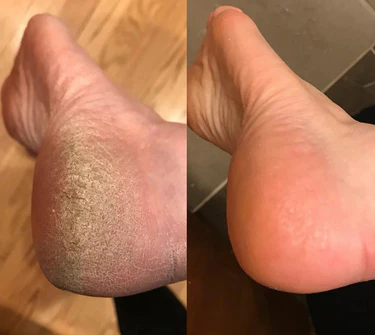 SoftFeet – Silky Smooth Feet in Minutes, Not Weeks