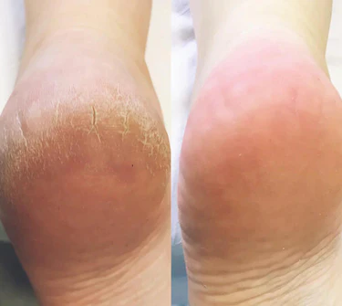 SoftFeet – Silky Smooth Feet in Minutes, Not Weeks