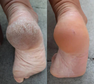 SoftFeet – Silky Smooth Feet in Minutes, Not Weeks